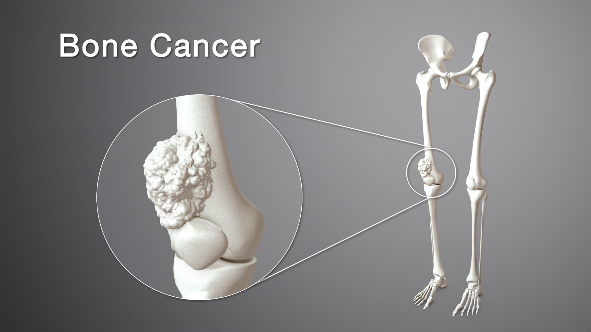 bone tumors